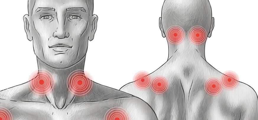 Fibromialgia Fibromialgia