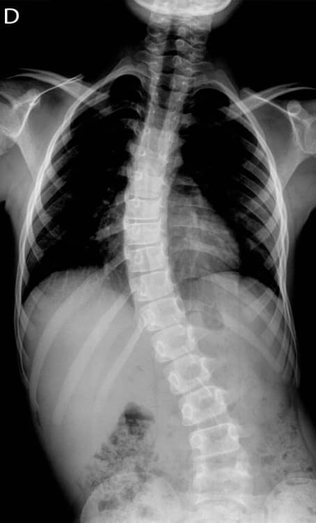 escoliosis - radiografia