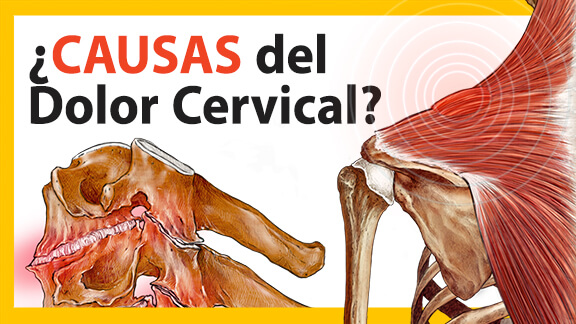 ¿qué Es El Dolor Cervical Origen De La Cervicalgia Fisiom