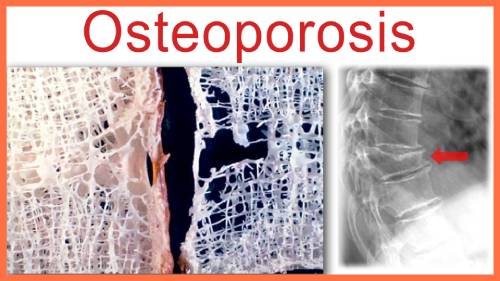 Cuidados para prevenir la Osteoporosis