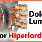 lumbalgia por hiperlordosis