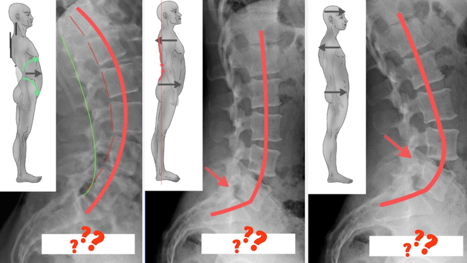 ¿Qué Cadenas Musculares pueden generar Hiperlordosis? ¿Qué Cadenas Musculares pueden generar Hiperlordosis?