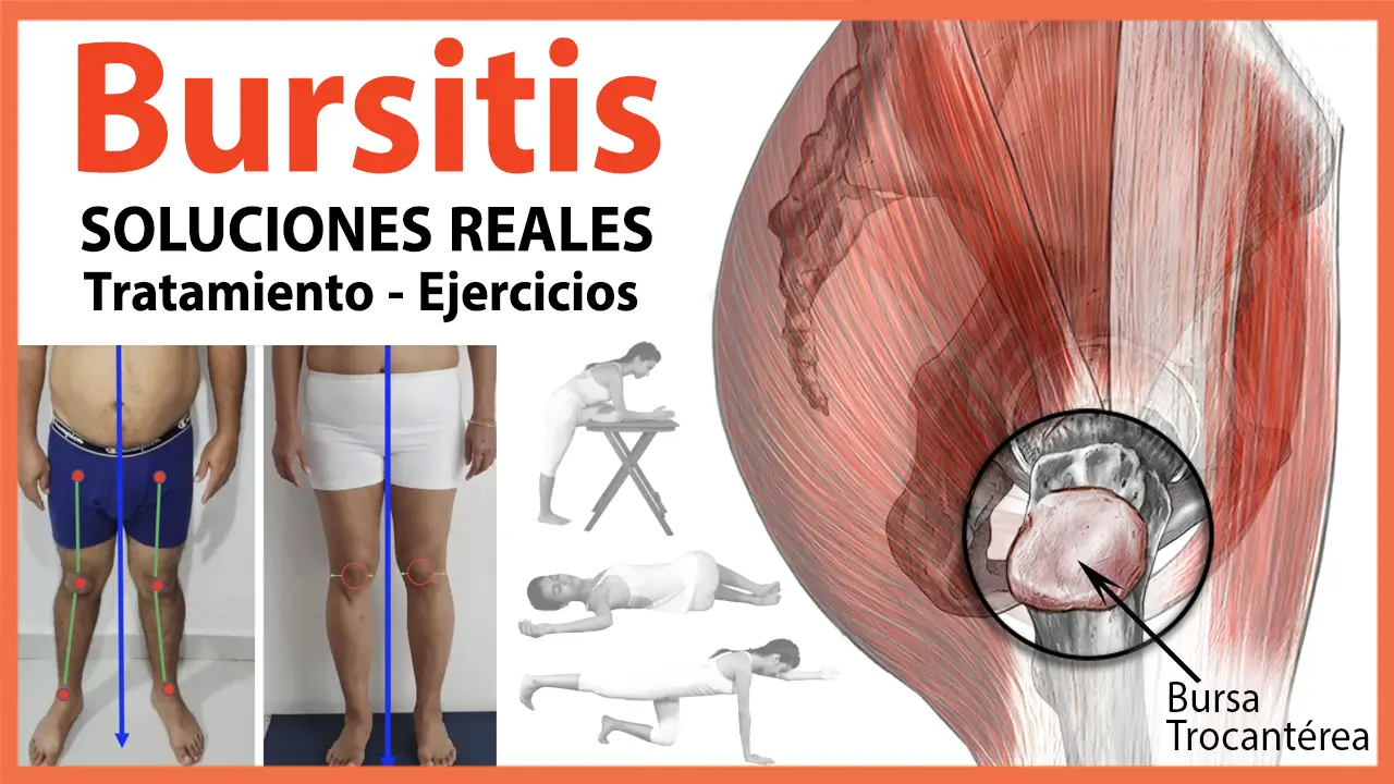 La Bursitis Trocantérea